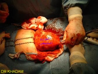 علاج الورم الليفي في FIBROME LAP.jpg